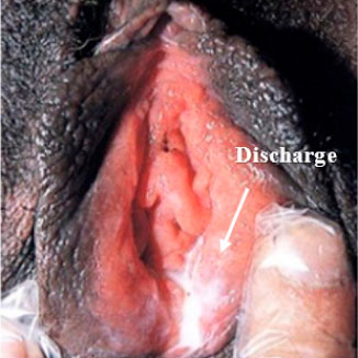 Vaginal gonorrhea