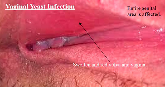 yeast infection bumps women
